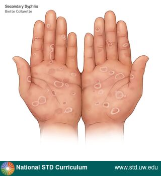 Diagnosis: Syphilis - Secondary, Clinical Signs: Scale, Locations: Hands, Light skin tone, Symptoms: N/A, Image Type: Illustration