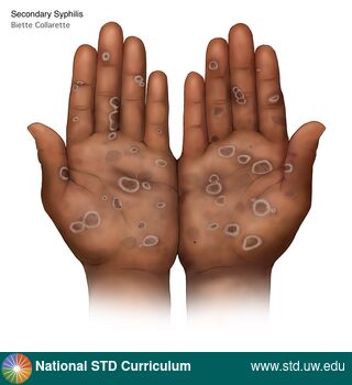 Diagnosis: Syphilis - Secondary, Clinical Signs: Scale, Locations: Dark skin tone, Hands, Symptoms: N/A, Image Type: Illustration