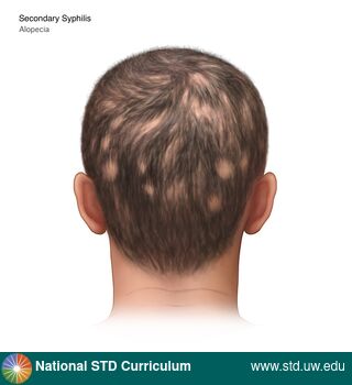 Diagnosis: Syphilis - Secondary, Clinical Signs: Annular, Patch/Patches, Locations: Head, Light skin tone, Symptoms: Non-Painful, Image Type: Illustration