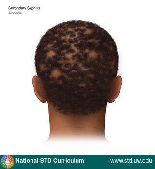 Diagnosis: Syphilis - Secondary, Clinical Signs: Annular, Patch/Patches, Locations: Head, Symptoms: Non-Painful, Image Type: Illustration