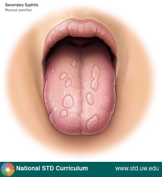 Diagnosis: Syphilis - Secondary, Clinical Signs: Patch/Patches, Locations: Light skin tone, Tongue, Symptoms: N/A, Image Type: Illustration