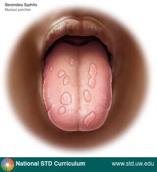 Diagnosis: Syphilis - Secondary, Clinical Signs: Patch/Patches, Locations: Dark skin tone, Tongue, Symptoms: N/A, Image Type: Illustration