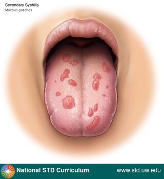 Diagnosis: Syphilis - Secondary, Clinical Signs: Erythema, Patch/Patches, Locations: Light skin tone, Tongue, Symptoms: N/A, Image Type: Illustration