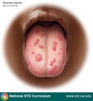 Diagnosis: Syphilis - Secondary, Clinical Signs: Erythema, Patch/Patches, Locations: Dark skin tone, Tongue, Symptoms: N/A, Image Type: Illustration