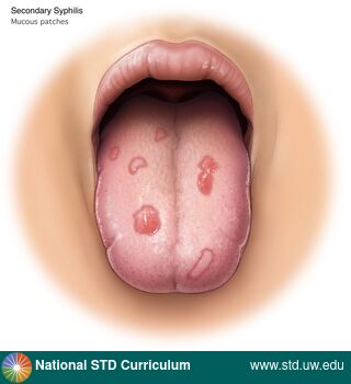 Diagnosis: Syphilis - Secondary, Clinical Signs: Patch/Patches, Locations: Light skin tone, Tongue, Symptoms: N/A, Image Type: Illustration