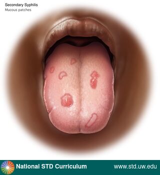 Diagnosis: Syphilis - Secondary, Clinical Signs: Patch/Patches, Locations: Dark skin tone, Tongue, Symptoms: N/A, Image Type: Illustration