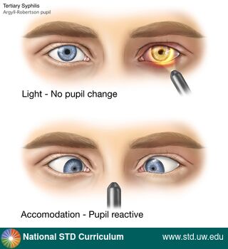 Diagnosis: Syphilis - Tertiary, Clinical Signs: N/A, Locations: Eye, Symptoms: N/A, Image Type: Illustration