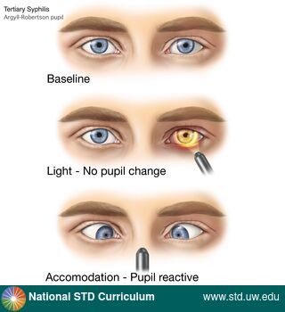 Diagnosis: Syphilis - Tertiary, Clinical Signs: N/A, Locations: Eye, Symptoms: N/A, Image Type: Illustration