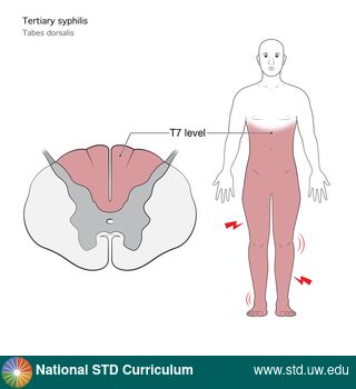 Diagnosis: Syphilis - Tertiary, Clinical Signs: N/A, Locations: Leg / Legs, Symptoms: N/A, Image Type: Illustration