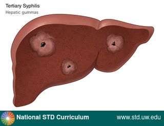Diagnosis: Syphilis - Tertiary, Clinical Signs: N/A, Locations: N/A, Symptoms: N/A, Image Type: Illustration