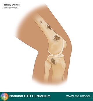 Diagnosis: Syphilis - Tertiary, Clinical Signs: N/A, Locations: Leg / Legs, Symptoms: N/A, Image Type: Illustration