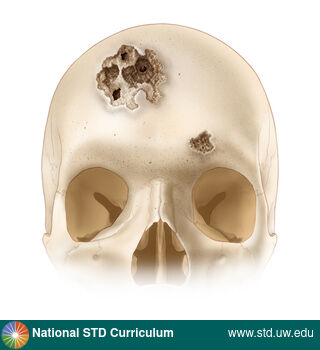 Diagnosis: Syphilis - Tertiary, Clinical Signs: N/A, Locations: Head, Symptoms: N/A, Image Type: Illustration