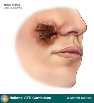 Diagnosis: Syphilis - Tertiary, Clinical Signs: Scab, Ulcer / Ulcers, Locations: Face, Symptoms: N/A, Image Type: Illustration