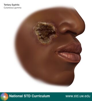 Diagnosis: Syphilis - Tertiary, Clinical Signs: Scab, Ulcer / Ulcers, Locations: Face, Symptoms: N/A, Image Type: Illustration