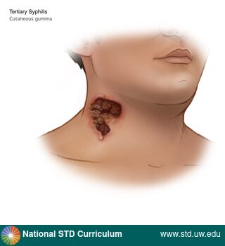 Diagnosis: Syphilis - Tertiary, Clinical Signs: Scab, Ulcer / Ulcers, Locations: Neck, Symptoms: N/A, Image Type: Illustration