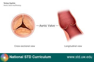 Diagnosis: Syphilis - Tertiary, Clinical Signs: N/A, Locations: N/A, Symptoms: N/A, Image Type: Illustration