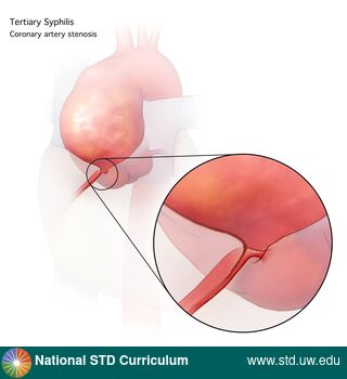 Diagnosis: Syphilis - Tertiary, Clinical Signs: N/A, Locations: N/A, Symptoms: N/A, Image Type: Illustration