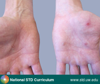 Diagnosis: Syphilis-Secondary, Clinical Signs: Annular, Hyperpigmentation, Papule / Papules, Locations: Hand (Left), Hand (Right), Hands, Symptoms: Non-Painful, Image Type: Photo