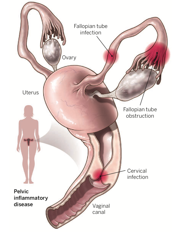 pelvic inflammatory disease ultrasound