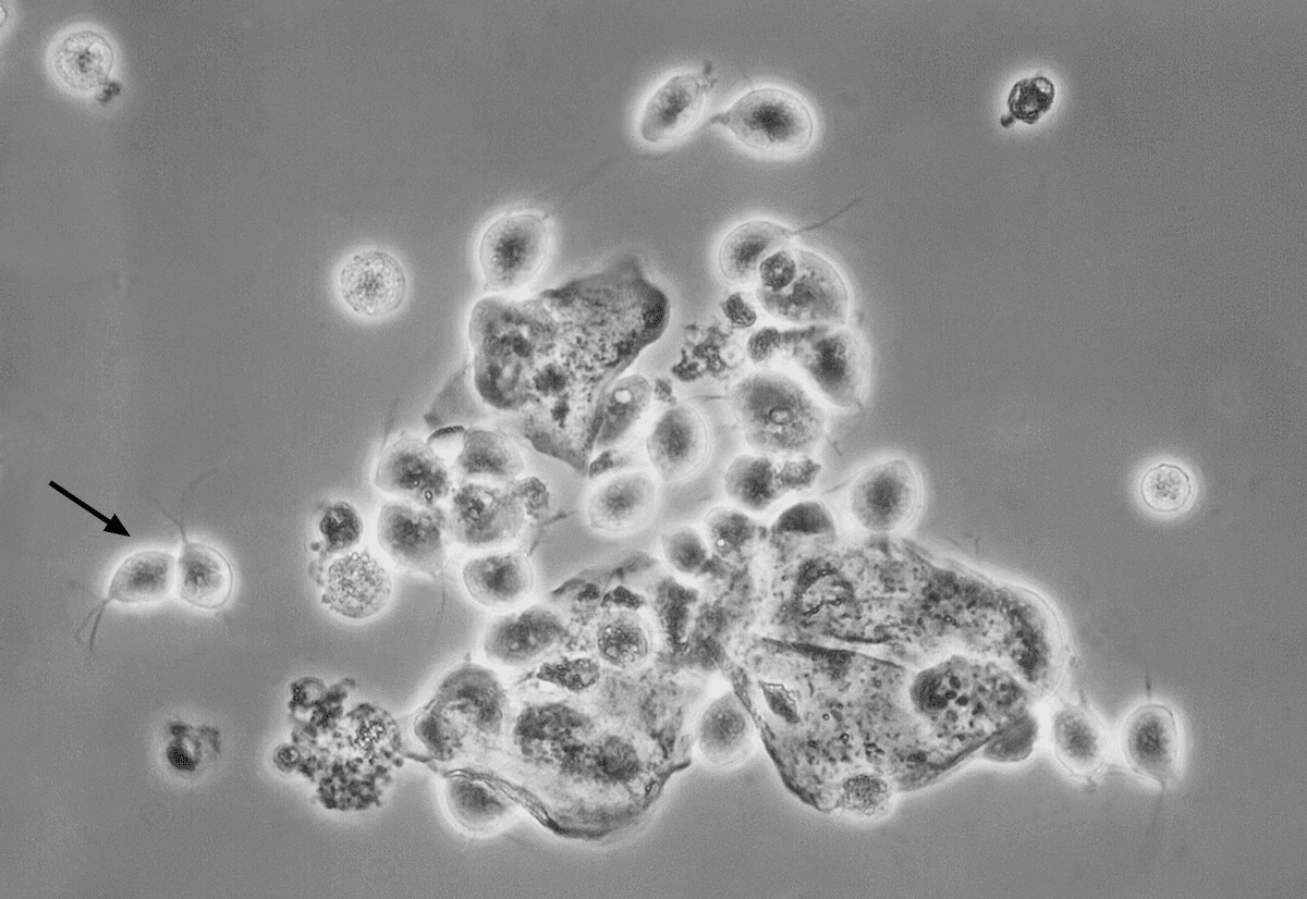 trichomonads and clue cells