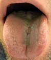 This man with primary syphilis developed an oral chancre on the tongue 