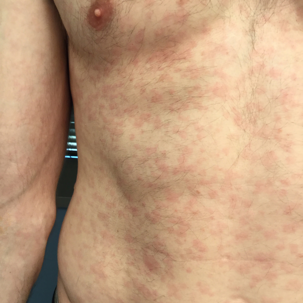 std skin rash on chest