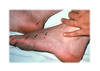 This patient had disseminated gonococcal infection including multiple cutaneous lesions on the feet (black arrows).