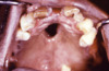 This photograph shows an intraoral view of a perforation in the hard palate caused by congenital syphilis.