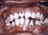 This photograph demonstrates the triangular-shaped deformity of an upper central incisor (top arrow) and a lower lateral incisor (lower arrow) dentition within the oral cavity of a person with a history of congenital syphilis. These dental abnormalities are known as Hutchinson incisors.