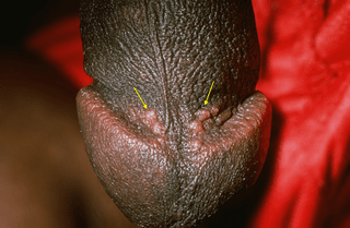 Papular Lesions on Tip of Penis