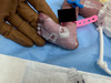 Right foot (Sole) of a neonate with congenital syphilis and multiple blisters in irregular outlines, including some that have ruptured. These features are characteristic of pemphigus syphiliticus.