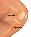 This inset shows a close-up view of inflammation of the distal metaphysis of the femur (top black arrow) and destruction of the medial metaphysis of the proximal left tibia (bottom black arrow).<br />
<br />
 