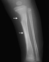 This radiograph, from an infant with congenital syphilis, shows multiple bony changes, including destruction of the medial metaphysis of the left tibia (top white arrow) and diffuse tibial periosteal reaction (bottom white arrow). These findings illustrate Wimberger sign