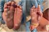 Extensive bullous rash of soles (image on left) and right palm (image on right) present at birth in an infant with congenital syphilis.