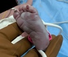 This photograph shows the plantar surface of the right foot of a neonate with congenital syphilis and pemphigus syphiliticus. There are multiple large blisters in irregular outlines and an erosion on the pad of the fourth toe. 