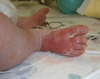 This photograph shows a large area of desquamation on the dorsal surface of the right foot in a newborn infant with pemphigus syphiliticus.