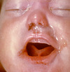This photograph shows an infant with early congenital syphilis and purulent rhinitis (“snuffles”).