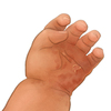 The rash associated with congenital syphilis often involves the soles and palms (as shown here on the palm of this infant’s right hand). The hand rash often becomes papular, followed by desquamation.  <br />
 