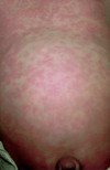 Photograph of a 2-month old boy with congenital syphilis showing erythematous macules and papules with some scaling in the upper chest. This bright red rash in this boy represents an early phase of the generalized rash with congenital syphilis; these lesions typically fade to a more copper or rust color.