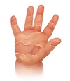The congenital syphilis rash often evolves with desquamation. This may involve localized desquamation or diffuse peeling of the skin.