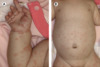 Diffuse macular bullous rash on arms, hands, and abdomen of a 1-month old infant with congenital syphilis (Panels A & B).