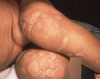 This photograph shows a newborn with congenital syphilis shows papulosquamous patches with Biett's collarette of scale on the anterior legs. This description of the collarette of scale was first described by Laurent-Théodore Biett in the early 19<sup>th</sup> century, refers to the narrow rim of peripheral scaling around syphilitic annular maculopapular lesions.