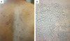 The image on left (A) shows diffuse, hyperpigmented oval lesions on the back, with some areas of fine scaling. The image on right (B) shows a potassium hydroxide (KOH) stain of a skin scraping viewed under the microscope.&nbsp;