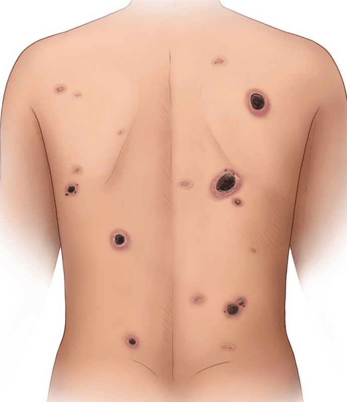 Multiple ulcerated, deep necrotic lesions on back.&nbsp;