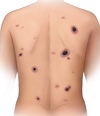 Multiple ulcerated, deep necrotic lesions on back.&nbsp;