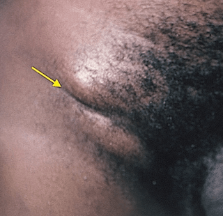 Right Inguinal Lymph Node Swelling: Groove Sign