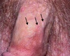 Multiple papular lesions, with central umbilication, on the shaft of the penis (black arrows)