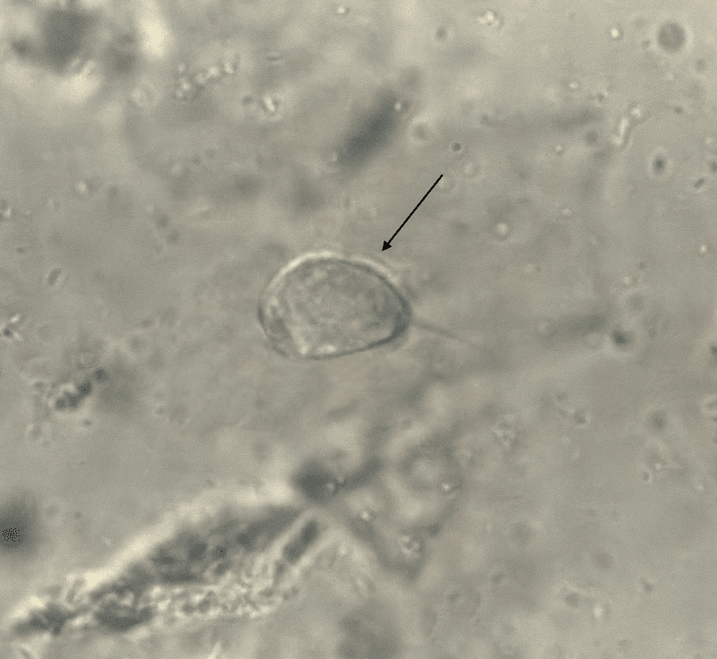 Figure 1 - Vaginal Swab Wet Mount Preparation Viewed Under Microscope