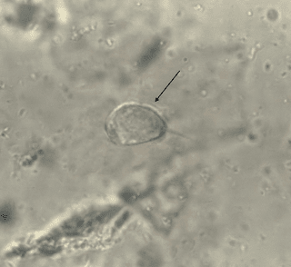 Vaginal Swab Wet Mount Preparation Viewed Under Microscope