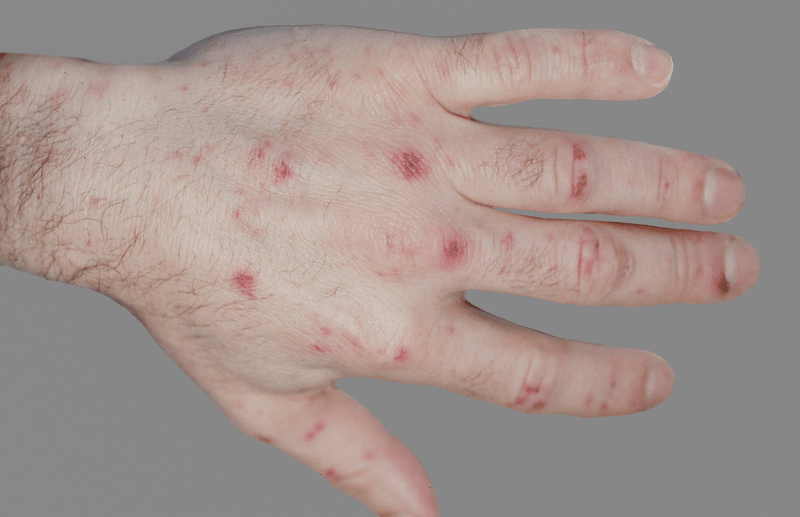 Figure 1 - Papular Rash on Left Hand with Excoriations from Scratching